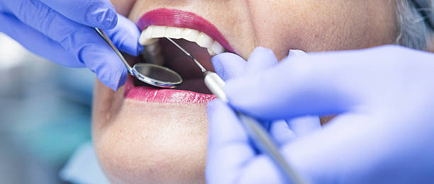 Teeth Whitening in CA